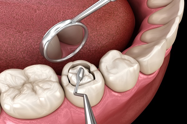 How A Dental Filling Can Treat Tooth Decay