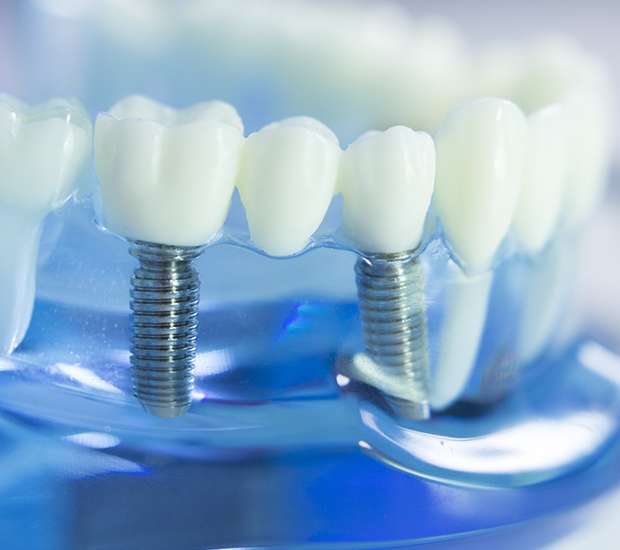 Doral Dental Implants