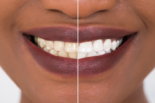 How Long Does Teeth Whitening From A Dentist Last?