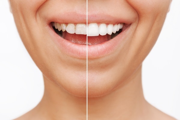 How Can Dental Veneers Reshape Teeth?